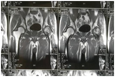 1536220677152934.png 术前患者MRI.png
